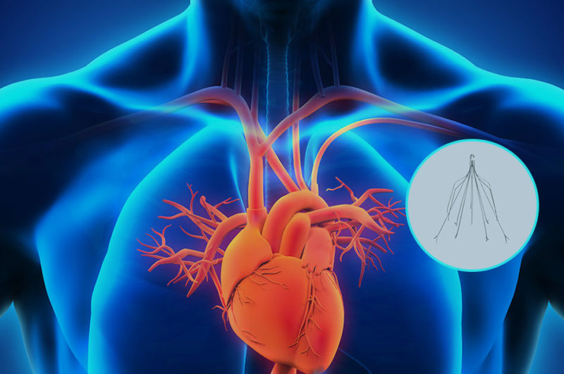 IVC Failed Blood Clot Filters Marc J. Bern & Partners LLP